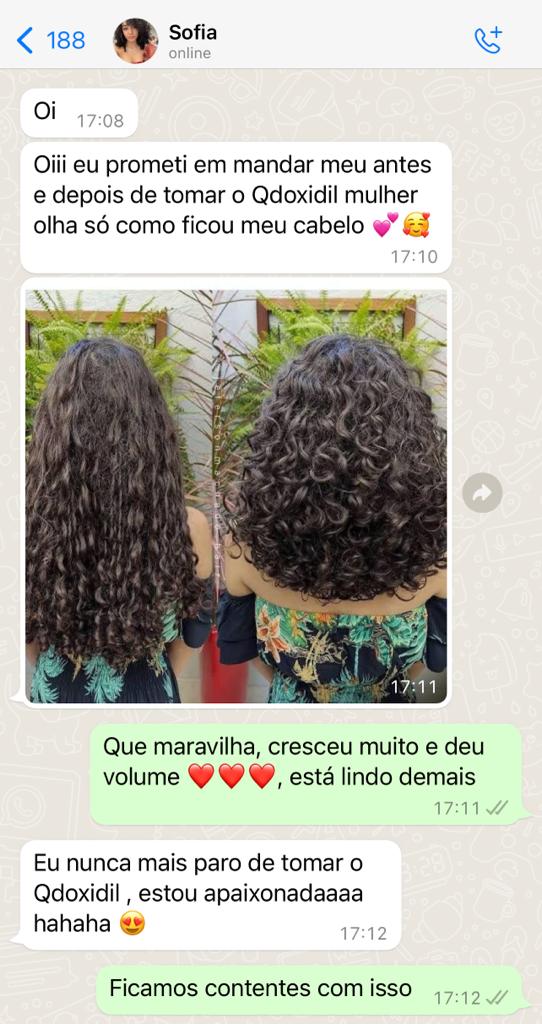 Qdoxidil-Mulher-Antes-e-Depois